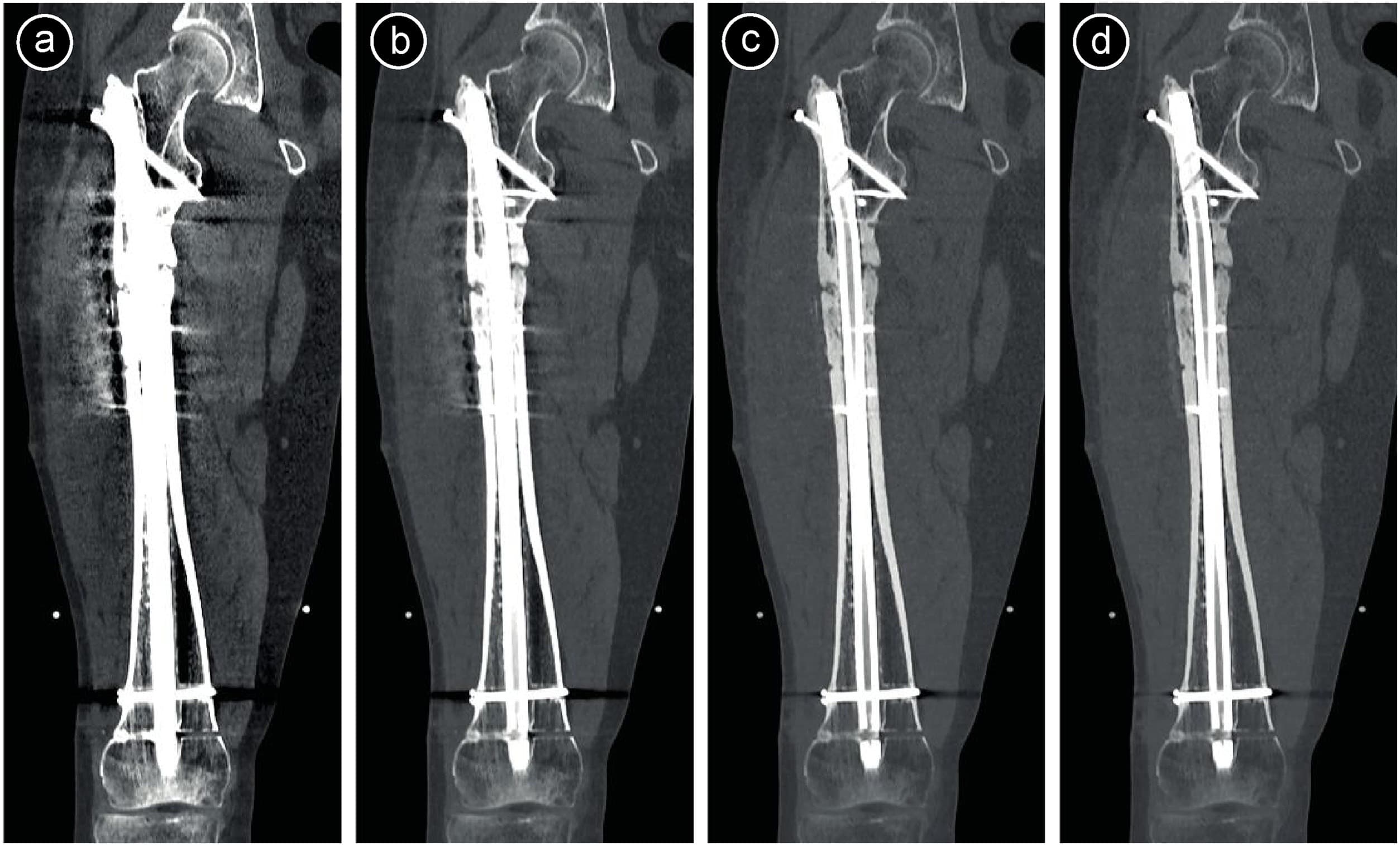 Metal Artifact Reduction